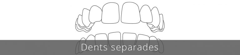 Els problemes d'espaiat poden provocar problemes en les genives, bosses periodontals i més probabilitat que es desenvolupin malalties a causa de la falta de protecció de les genives per les dents.