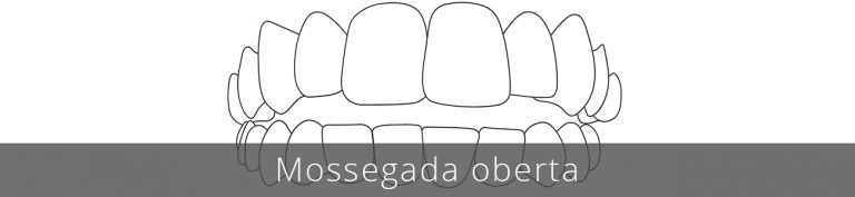 La mossegada oberta pot provocar problemes de masticació, dificultat per parlar i problemes més greus, com patologies de l'articulació temporomandibular (Patm).